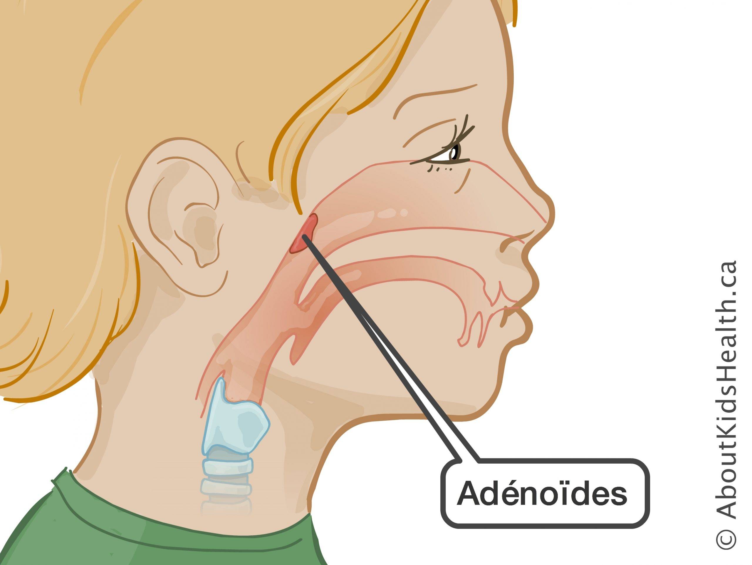 Recréer la sinusite : les végétations adénoïdes et le reflux peuvent également être causés