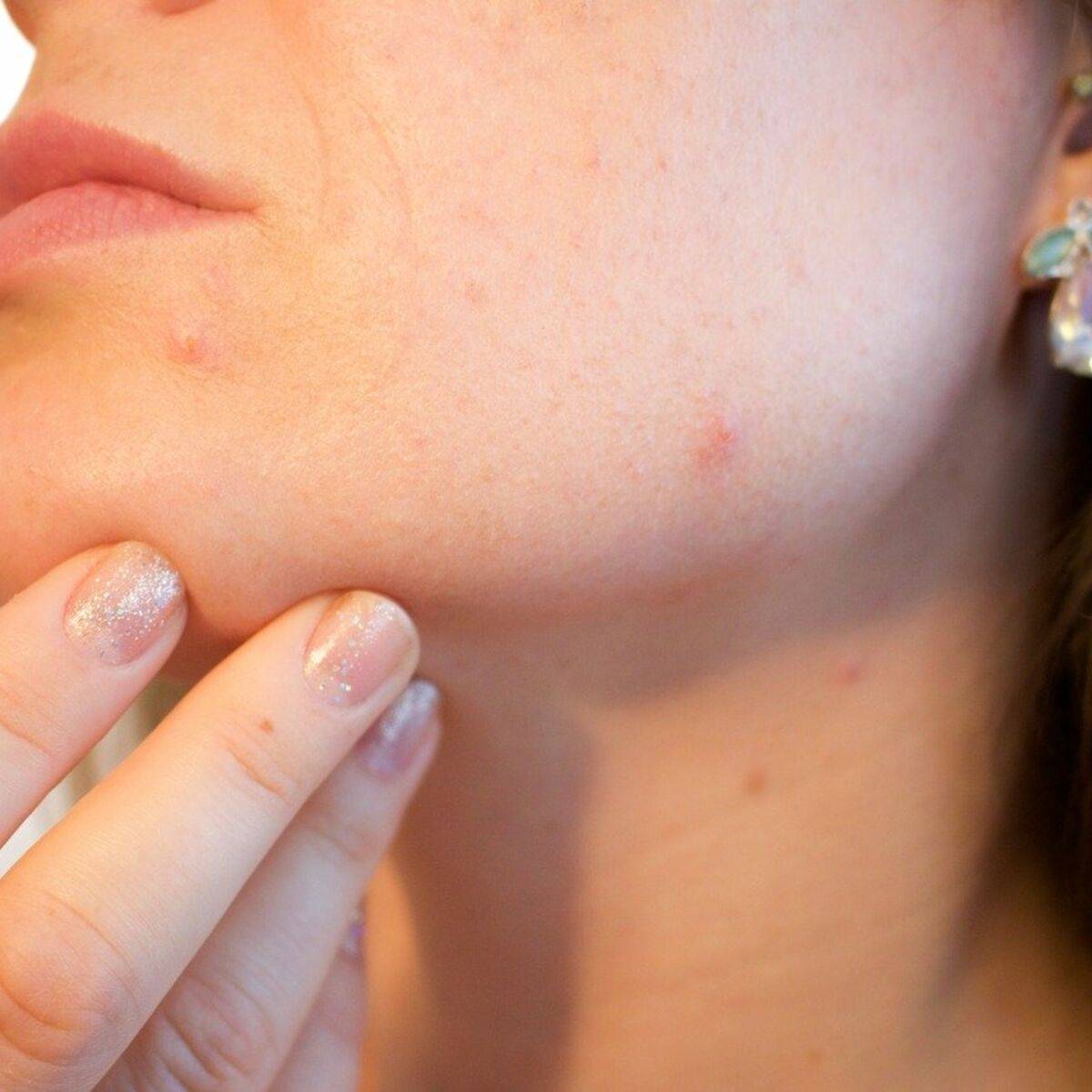 Récess à l’acné : adoucissant l’acné naturelle